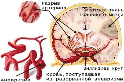 Инсульт